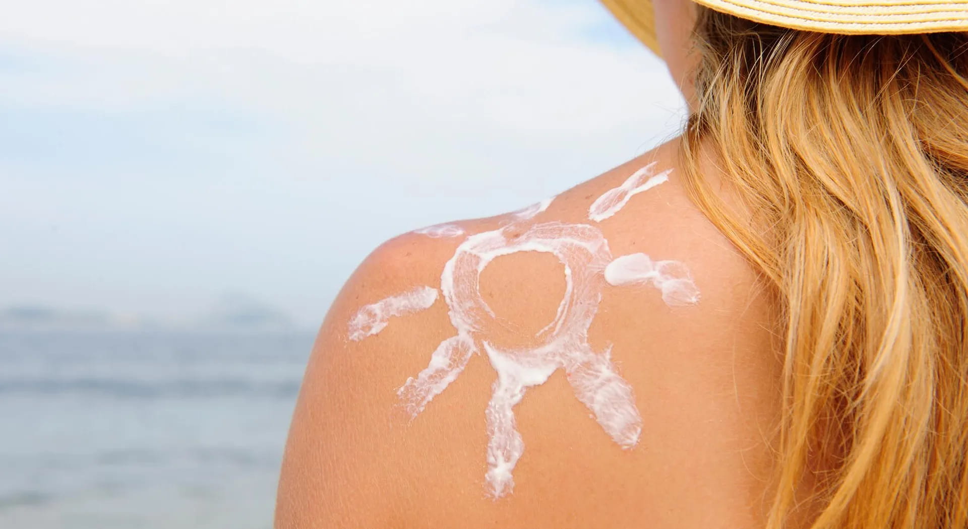 5 rimedi naturali contro le bruciature del sole